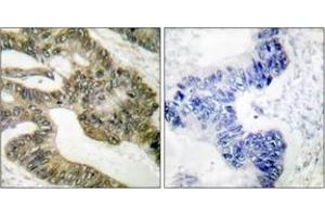 Immunohistochemistry analysis of paraffin-embedded human colon carcinoma tissue, using APC Antibody.