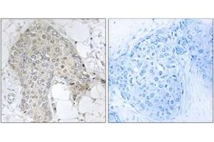 Immunohistochemistry analysis of paraffin-embedded human breast carcinoma tissue, using PPP1R2 (Ab-120/121) Antibody. (PPP1R2 anticorps  (AA 86-135))
