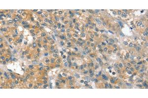 Immunohistochemistry of paraffin-embedded Human liver cancer using PPP2CA Polyclonal Antibody at dilution of 1:35 (PPP2CA anticorps)