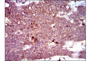 Immunohistochemical analysis of paraffin-embedded ovarian cancer tissues using DCTN4 mouse mAb with DAB staining. (Dynactin 4 anticorps  (AA 57-298))
