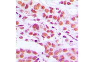 Immunohistochemical analysis of Histone H3 (pS10) staining in human breast cancer formalin fixed paraffin embedded tissue section. (Histone 3 anticorps  (pSer10))