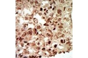 Formalin-fixed and paraffin-embedded human cancer tissue reacted with the primary antibody, which was peroxidase-conjugated to the secondary antibody, followed by AEC staining.