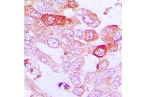 Immunohistochemical analysis of A20 staining in human lung cancer formalin fixed paraffin embedded tissue section.