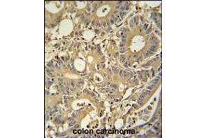 TPSD1 antibody immunohistochemistry analysis in formalin fixed and paraffin embedded human colon carcinoma followed by peroxidase conjugation of the secondary antibody and DAB staining. (TPSD1 anticorps  (C-Term))