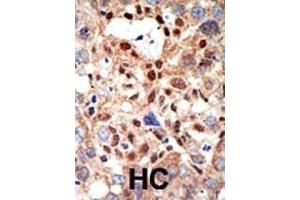 Formalin-fixed and paraffin-embedded human cancer tissue reacted with the primary antibody, which was peroxidase-conjugated to the secondary antibody, followed by DAB staining.