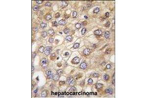 Formalin-fixed and paraffin-embedded human hepatocarcinoma tissue reacted with CLDN2 (Human N-term) (ABIN390291 and ABIN2840730) , which was peroxidase-conjugated to the secondary antibody, followed by DAB staining.