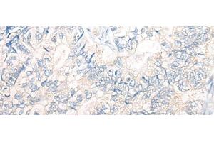Immunohistochemistry of paraffin-embedded Human gastric cancer tissue using PNPO Polyclonal Antibody at dilution of 1:30(x200)