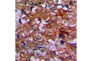 Immunohistochemical analysis of EPHA1 staining in human prostate cancer formalin fixed paraffin embedded tissue section. (EPHA1 anticorps)