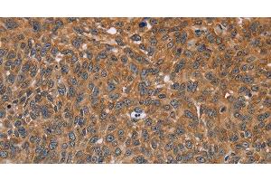 Immunohistochemistry of paraffin-embedded Human lung cancer using GH2 Polyclonal Antibody at dilution of 1:40 (Growth Hormone 2 anticorps)