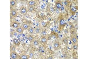 Immunohistochemistry of paraffin-embedded Human liver damage using TLK2 Polyclonal Antibody at dilution of 1:100 (40x lens). (TLK2 anticorps)