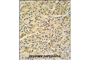 HOXA3 Antibody (C-term) (ABIN653846 and ABIN2843109) IHC analysis in formalin fixed and paraffin embedded prostate carcinoma followed by peroxidase conjugation of the secondary antibody and DAB staining. (HOXA3 anticorps  (C-Term))