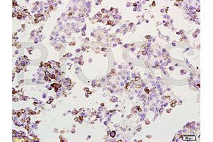 Formalin-fixed and paraffin embedded rat lung melanoma labeled with Anti-MAGE-1 Polyclonal Antibody, Unconjugated (ABIN728578) at 1:200, followed by conjugation to the secondary antibody and DAB staining (MAGEA1 anticorps  (AA 101-200))