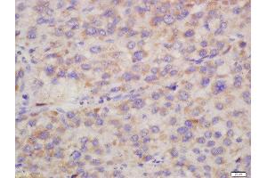 Formalin-fixed and paraffin embedded human liver carcinoma labeled with Rabbit Anti-Hepsin Polyclonal Antibody, Unconjugated (ABIN716816) at 1:200 followed by conjugation to the secondary antibody and DAB staining