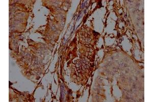 IHC image of ABIN7127408 diluted at 1:100 and staining in paraffin-embedded human endometrial cancer performed on a Leica BondTM system.