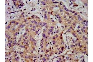 IHC image of ABIN7175596 diluted at 1:500 and staining in paraffin-embedded human liver cancer performed on a Leica BondTM system.