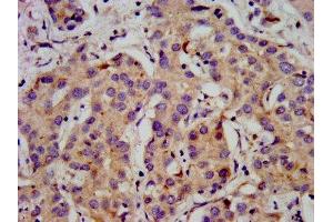 IHC image of ABIN7175596 diluted at 1:500 and staining in paraffin-embedded human liver cancer performed on a Leica BondTM system. (CACNB2 anticorps  (AA 490-637))