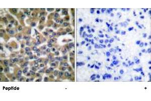 Immunohistochemical analysis of paraffin-embedded human breast carcinoma tissue using EEF2 polyclonal antibody . (EEF2 anticorps  (Thr56))
