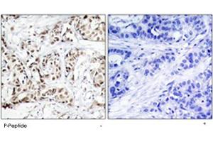 Immunohistochemical analysis of paraffin-embedded human breast carcinoma tissue using MAPK9/MAPK10 (phospho T183) polyclonal antibody . (JNK2 anticorps  (pThr183))