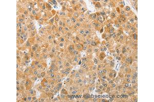 Immunohistochemistry of Human liver cancer using ATG5 Polyclonal Antibody at dilution of 1:40 (ATG5 anticorps)