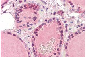 Human Thyroid (formalin-fixed, paraffin-embedded) stained with EPHA2 antibody ABIN364396 at 5 ug/ml followed by biotinylated anti-mouse IgG secondary antibody ABIN481714, alkaline phosphatase-streptavidin and chromogen. (EPH Receptor A2 anticorps  (AA 559-976))