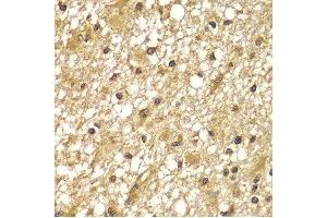 Immunohistochemistry of paraffin-embedded human brain cancer using PIK3R3 antibody at dilution of 1:100 (x400 lens). (PIK3R3 anticorps)