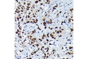 Immunohistochemistry of paraffin-embedded human breast cancer using C/EBPB Rabbit pAb (ABIN6134025, ABIN6138382, ABIN6138383 and ABIN6213964) at dilution of 1:100 (40x lens). (CEBPB anticorps  (AA 150-250))