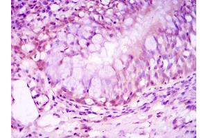 Immunohistochemical analysis of paraffin-embedded lung cancer tissues using NR3C1 mouse mAb with DAB staining.