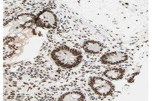 ABIN6266629 at 1/100 staining human colon carcinoma tissue sections by IHC-P. (RCBTB1 anticorps  (Internal Region))