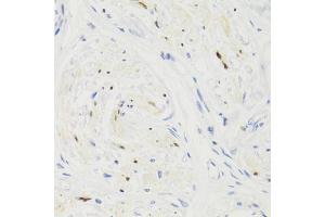 Immunohistochemistry of paraffin-embedded human breast cancer using GEMIN2 Antibody (ABIN1872798) at dilution of 1:100 (40x lens). (SIP1 anticorps)