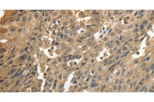 Immunohistochemistry of paraffin-embedded Human ovarian cancer using GSR Polyclonal Antibody at dilution of 1:50 (Glutathione Reductase anticorps)