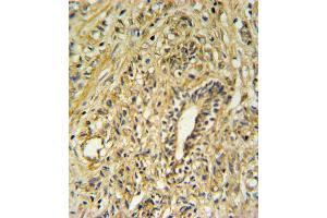 HSD17B2 Antibody IHC analysis in formalin fixed and paraffin embedded human prostate carcinoma followed by peroxidase conjugation of the secondary antibody and DAB staining. (HSD17B2 anticorps  (AA 265-294))