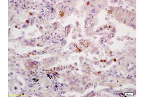 Formalin-fixed and paraffin embedded human lung carcinoma labeled with Anti-SDHB Polyclonal Antibody, Unconjugated (ABIN719411) at 1:200 followed by conjugation to the secondary antibody and DAB staining.