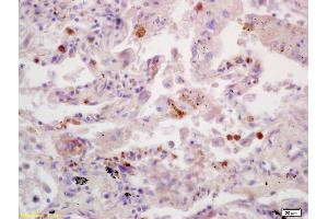 Formalin-fixed and paraffin embedded human lung carcinoma labeled with Anti-SDHB Polyclonal Antibody, Unconjugated (ABIN719411) at 1:200 followed by conjugation to the secondary antibody and DAB staining. (SDHB anticorps  (AA 201-280))