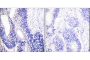 Immunohistochemistry analysis of paraffin-embedded human colon carcinoma tissue, using Claudin 3 Antibody. (Claudin 3 anticorps  (AA 171-220))