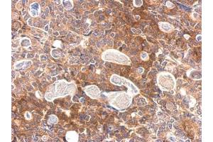 IHC-P Image Slap antibody detects SLA protein at cytosol on human gastric cancer by immunohistochemical analysis.