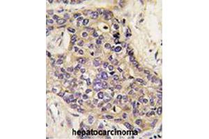 Formalin-fixed and paraffin-embedded human hepatocellular carcinoma reacted with HGF polyclonal antibody  , which was peroxidase-conjugated to the secondary antibody, followed by DAB staining. (HGF anticorps  (AA 521-554))