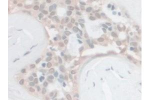 Detection of PCSK1 in Human Breast cancer Tissue using Polyclonal Antibody to Proprotein Convertase Subtilisin/Kexin Type 1 (PCSK1)