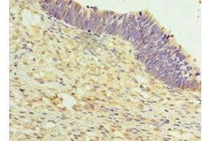 Immunohistochemistry of paraffin-embedded human ovarian cancer using ABIN7159637 at dilution of 1:100 (TET2 anticorps  (AA 1833-2002))