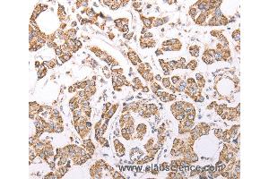 Immunohistochemistry of Human breast cancer using ATPIF1 Polyclonal Antibody at dilution of 1:60