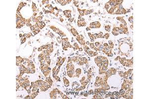 Immunohistochemistry of Human breast cancer using ATPIF1 Polyclonal Antibody at dilution of 1:60 (ATPase Inhibitory Factor 1 anticorps)