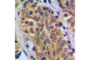 Immunohistochemical analysis of HEXB staining in human prostate cancer formalin fixed paraffin embedded tissue section. (HEXB anticorps  (C-Term))