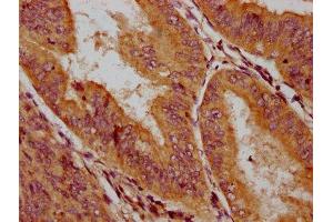 IHC image of ABIN7145611 diluted at 1:200 and staining in paraffin-embedded human endometrial cancer performed on a Leica BondTM system.