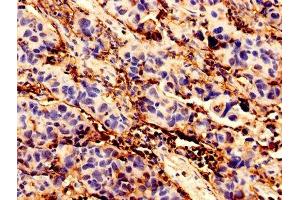 Immunohistochemistry analysis of human bladder cancer using ABIN7145741 at dilution of 1:100 (BCAT1 anticorps  (AA 4-276))