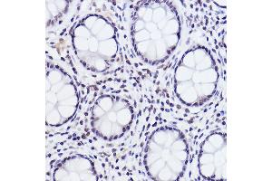 Immunohistochemistry of paraffin-embedded human colon carcinoma using Phospho-c-Jun-S243 Rabbit pAb (ABIN3023576, ABIN3023577, ABIN3023578 and ABIN6225416) at dilution of 1:25 (40x lens).