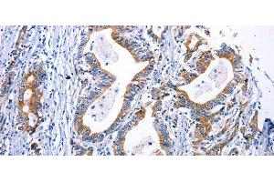 Immunohistochemistry of paraffin-embedded Human gastric cancer using DRD4 Polyclonal Antibody at dilution of 1:30 (DRD4 anticorps)