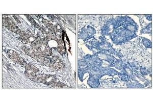 Immunohistochemical analysis of paraffin-embedded human breast carcinoma tissue using p53(Phospho-Ser6) Antibody(left) or the same antibody preincubated with blocking peptide(right).