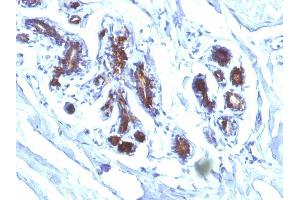 Formalin-fixed, paraffin-embedded human Breast Carcinoma stained with Milk Fat Globule Monoclonal Antibody (EDM45)