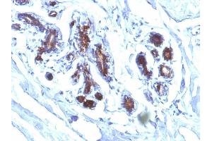 Formalin-fixed, paraffin-embedded human Breast Carcinoma stained with Milk Fat Globule Monoclonal Antibody (EDM45) (MFGE8 anticorps)