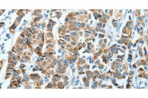 Immunohistochemistry of paraffin-embedded Human breast cancer using ALDH4A1 Polyclonal Antibody at dilution of 1:45