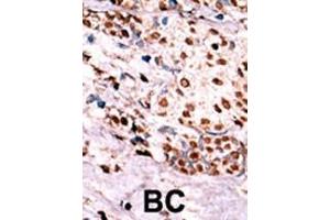 Formalin-fixed and paraffin-embedded human cancer tissue reacted with the primary antibody, which was peroxidase-conjugated to the secondary antibody, followed by AEC staining. (c-MET anticorps  (pTyr1349))